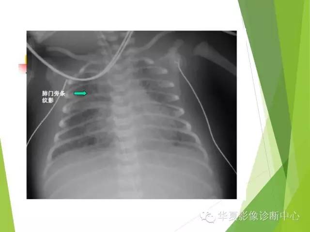 【PPT】新生儿常见的胸部病变