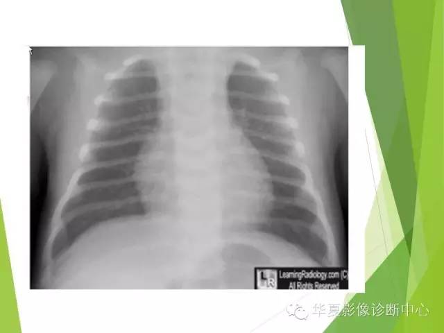 【PPT】新生儿常见的胸部病变