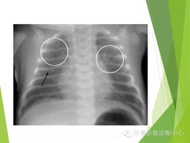 【PPT】新生儿常见的胸部病变