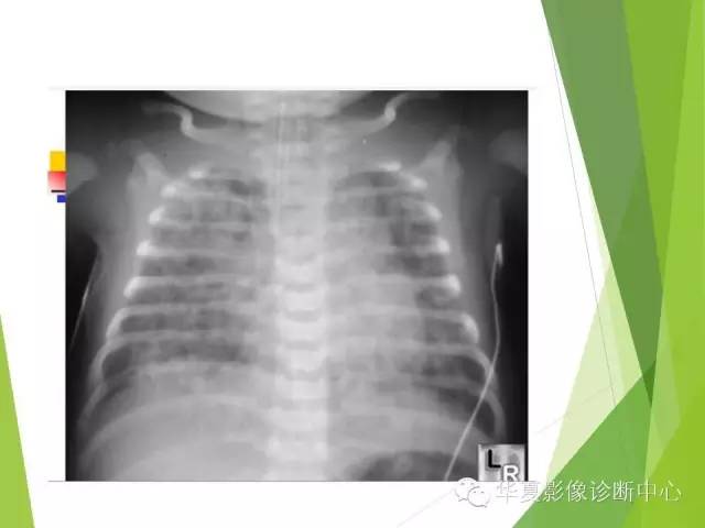 【PPT】新生儿常见的胸部病变