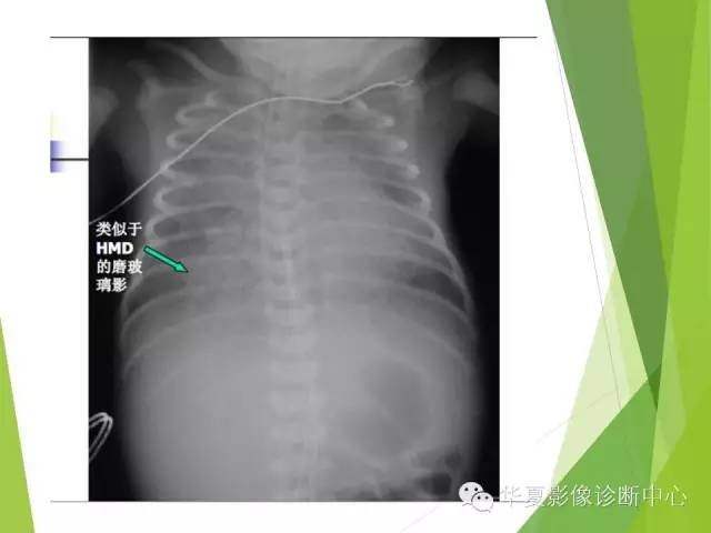 【PPT】新生儿常见的胸部病变