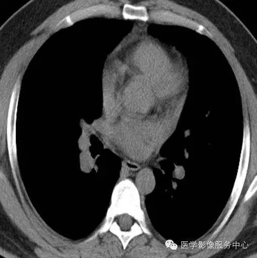 【病例】肺神经内分泌瘤1例CT影像表现 【病例】肺神经内分泌瘤1例CT影像表现