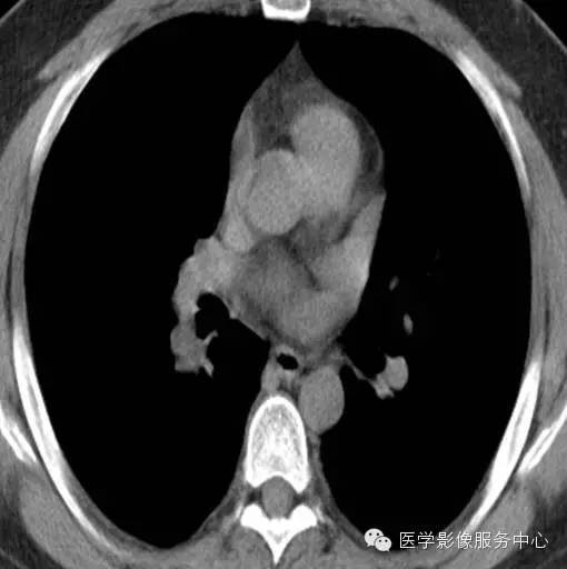 【病例】肺神经内分泌瘤1例CT影像表现 【病例】肺神经内分泌瘤1例CT影像表现