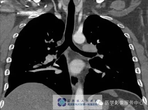【病例】肺神经内分泌瘤1例CT影像表现 【病例】肺神经内分泌瘤1例CT影像表现