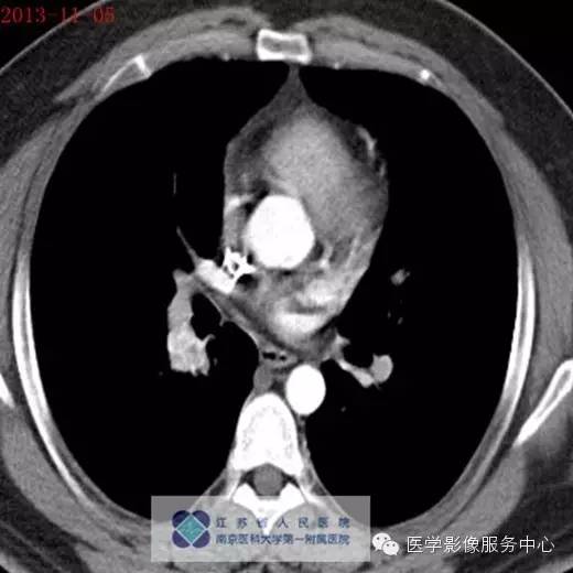 【病例】肺神经内分泌瘤1例CT影像表现 【病例】肺神经内分泌瘤1例CT影像表现