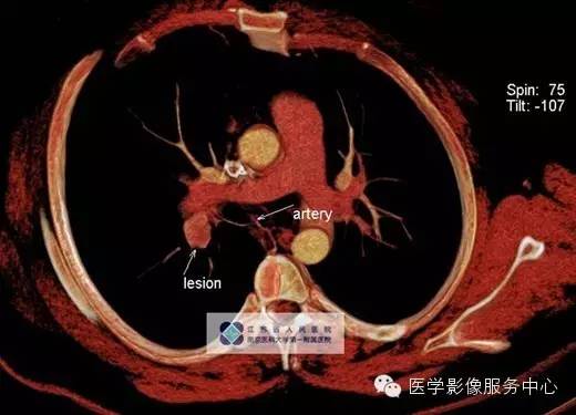 【病例】肺神经内分泌瘤1例CT影像表现 【病例】肺神经内分泌瘤1例CT影像表现