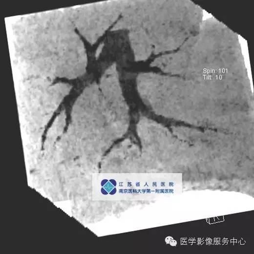 【病例】肺神经内分泌瘤1例CT影像表现 【病例】肺神经内分泌瘤1例CT影像表现