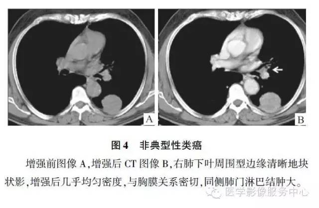 【病例】肺神经内分泌瘤1例CT影像表现 【病例】肺神经内分泌瘤1例CT影像表现