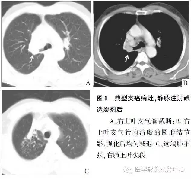 【病例】肺神经内分泌瘤1例CT影像表现 【病例】肺神经内分泌瘤1例CT影像表现