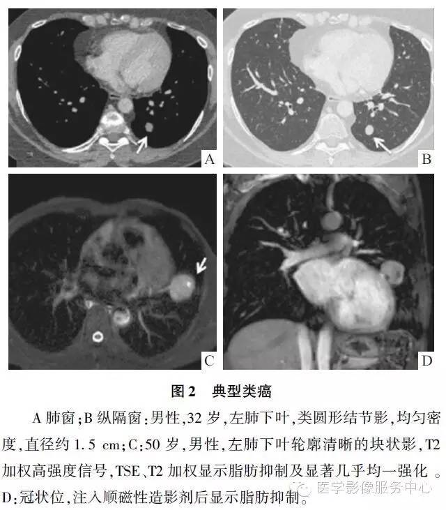 【病例】肺神经内分泌瘤1例CT影像表现 【病例】肺神经内分泌瘤1例CT影像表现