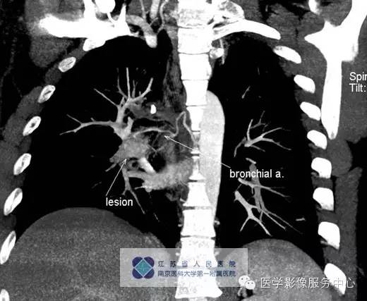 【病例】肺神经内分泌瘤1例CT影像表现 【病例】肺神经内分泌瘤1例CT影像表现