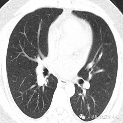 【病例】肺神经内分泌瘤1例CT影像表现 【病例】肺神经内分泌瘤1例CT影像表现