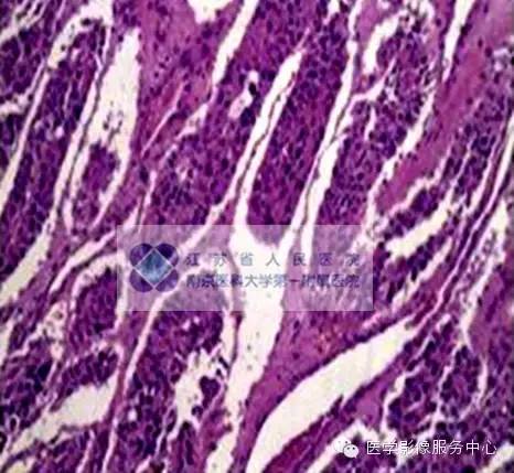 【病例】肺神经内分泌瘤1例CT影像表现 【病例】肺神经内分泌瘤1例CT影像表现