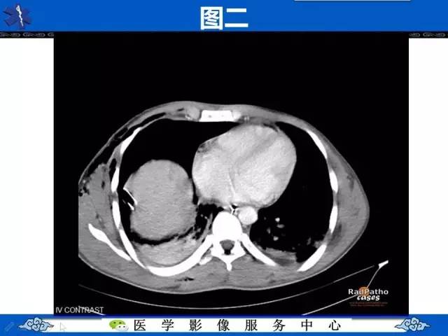 【影像征象】圆锥面包征——膈肌破裂