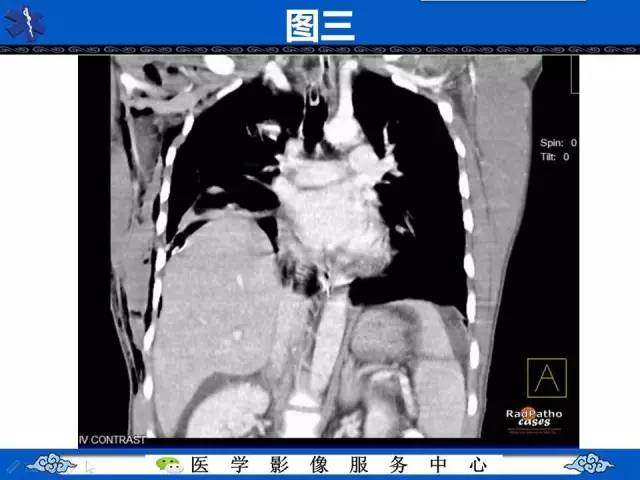 【影像征象】圆锥面包征——膈肌破裂