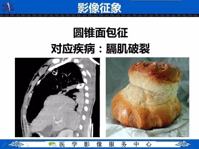 【影像征象】圆锥面包征——膈肌破裂