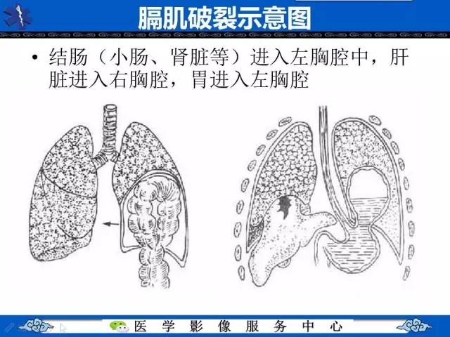 【影像征象】圆锥面包征——膈肌破裂