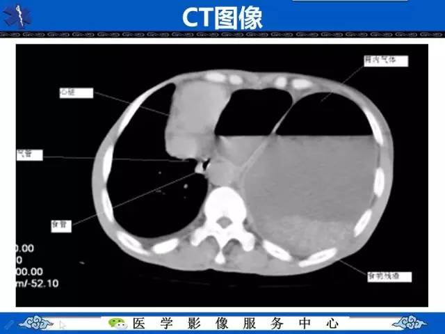 【影像征象】圆锥面包征——膈肌破裂