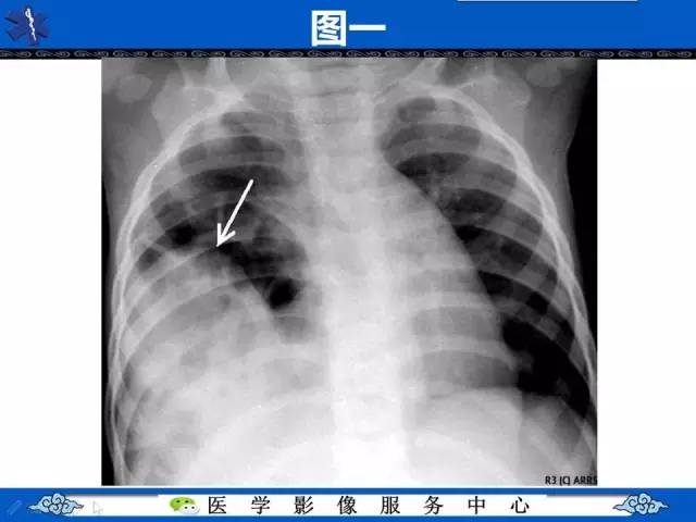 【影像征象】圆锥面包征——膈肌破裂