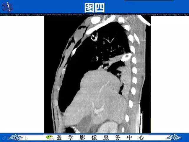 【影像征象】圆锥面包征——膈肌破裂