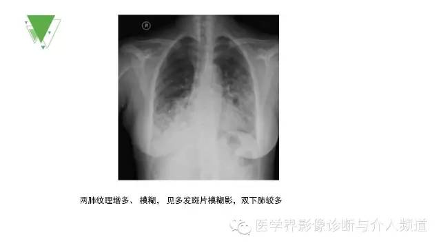 【PPT】细支气管肺泡肺癌的CT诊断