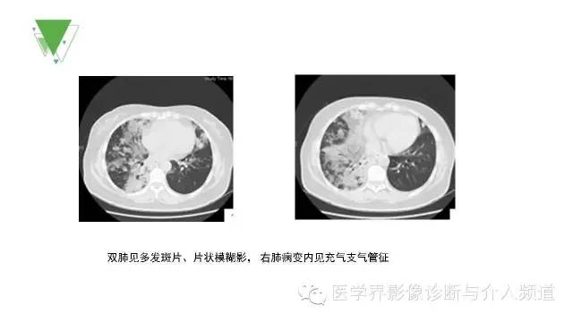 【PPT】细支气管肺泡肺癌的CT诊断