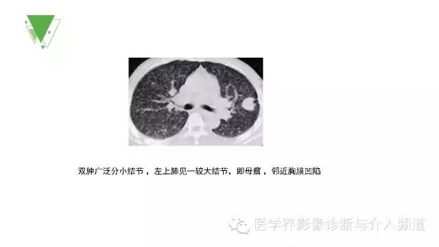 【PPT】细支气管肺泡肺癌的CT诊断