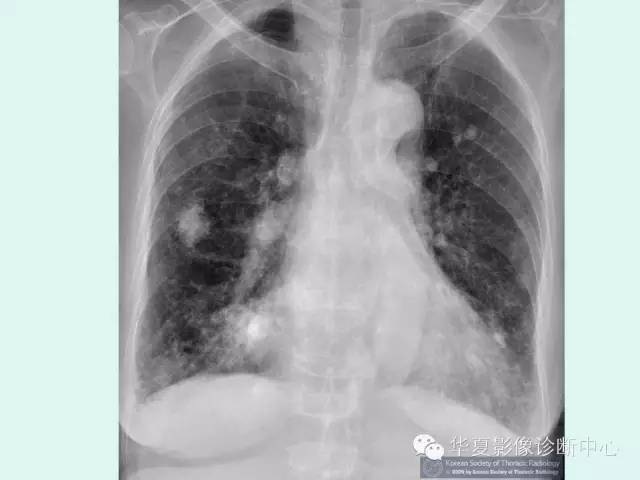 【病例】肺淀粉样变性1例CT影像表现