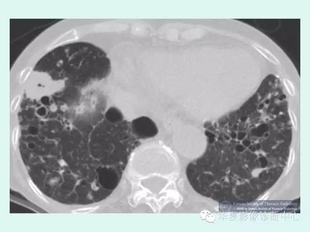【病例】肺淀粉样变性1例CT影像表现