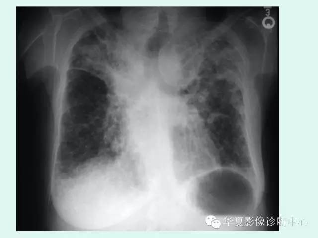 【病例】肺淀粉样变性1例CT影像表现