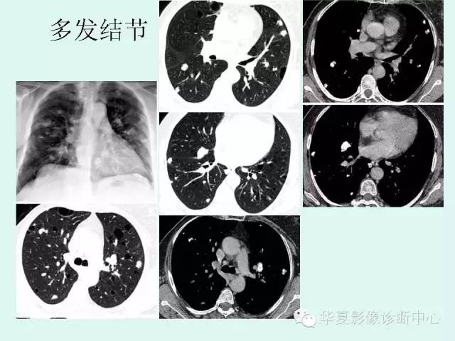 【病例】肺淀粉样变性1例CT影像表现