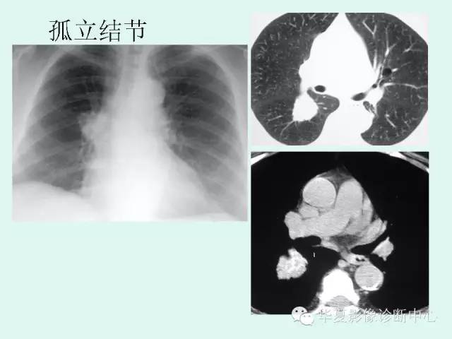 【病例】肺淀粉样变性1例CT影像表现