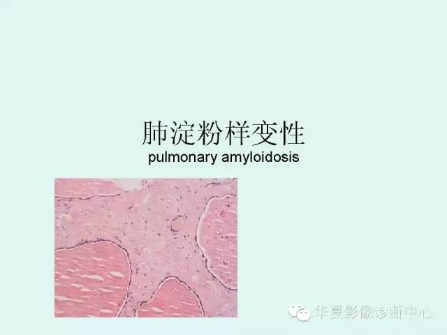 【病例】肺淀粉样变性1例CT影像表现