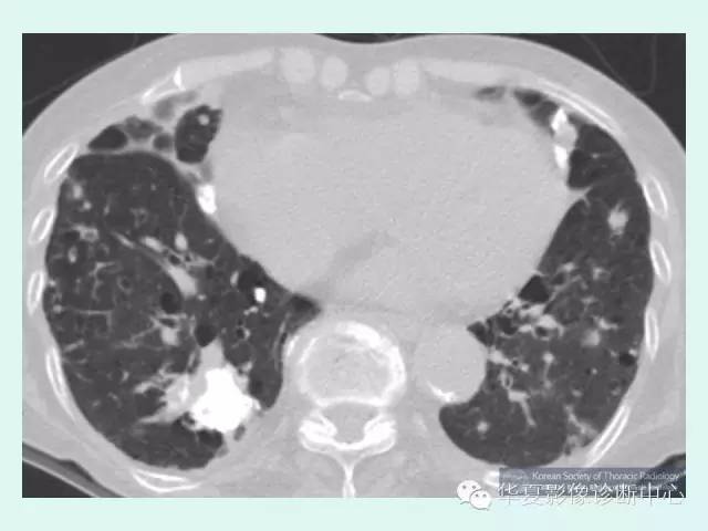 【病例】肺淀粉样变性1例CT影像表现