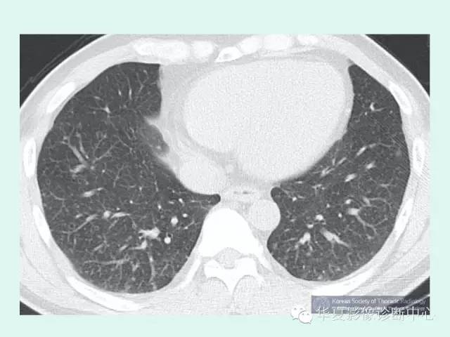 【病例】肺郎格汉斯细胞组织细胞增生症1例 【病例】肺郎格汉斯细胞组织细胞增生症1例