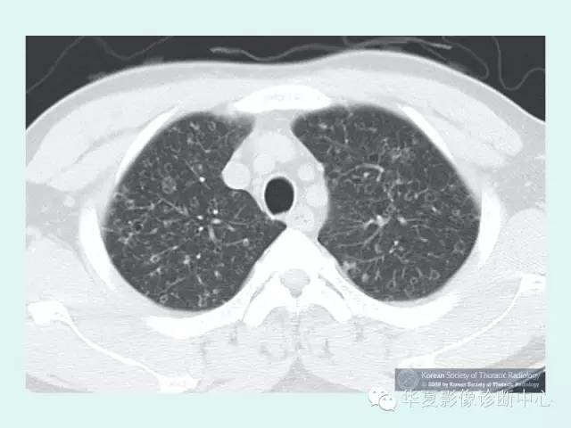 【病例】肺郎格汉斯细胞组织细胞增生症1例 【病例】肺郎格汉斯细胞组织细胞增生症1例