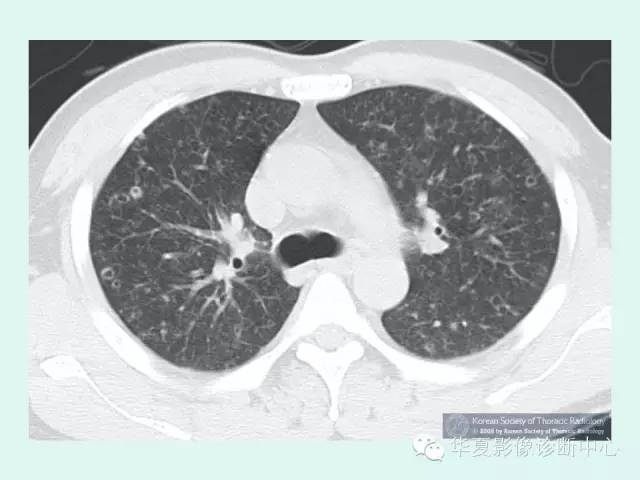 【病例】肺郎格汉斯细胞组织细胞增生症1例 【病例】肺郎格汉斯细胞组织细胞增生症1例