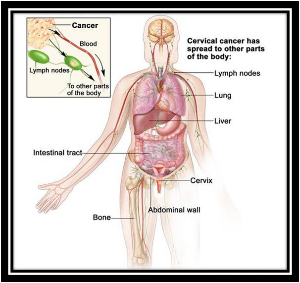 【病例】宫颈癌肺转移1例X线影像 【病例】宫颈癌肺转移1例X线影像