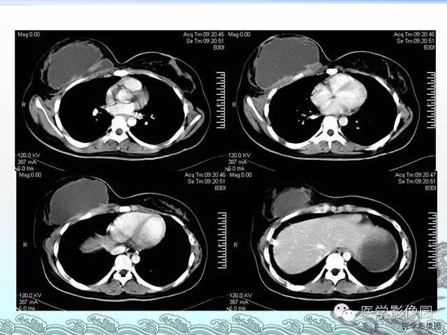 【病例】胸壁结核1例影像表现
