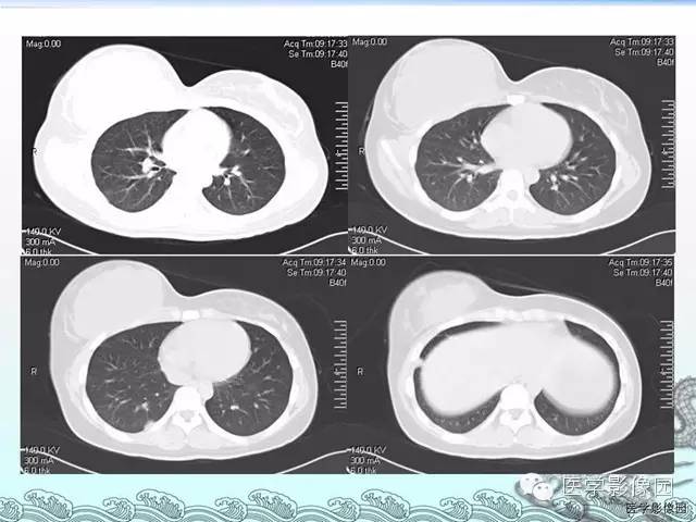 【病例】胸壁结核1例影像表现