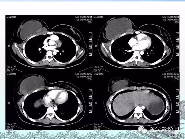 【病例】胸壁结核1例影像表现