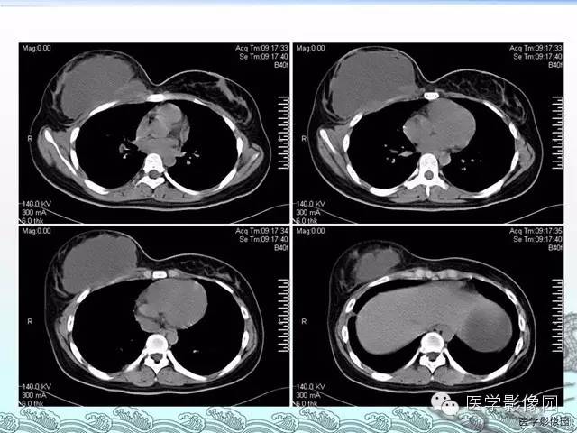 【病例】胸壁结核1例影像表现