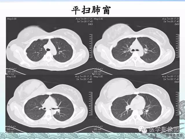 【病例】胸壁结核1例影像表现