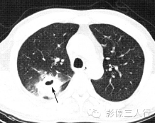 肺空洞性病变的鉴别诊断
