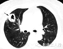 肺空洞性病变的鉴别诊断