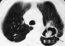 肺空洞性病变的鉴别诊断