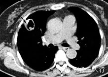 肺空洞性病变的鉴别诊断