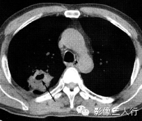肺空洞性病变的鉴别诊断