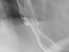 反流性食管炎1例X线影像表现