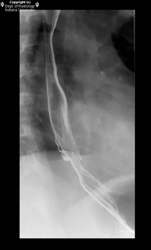 【病例】反流性食管炎1例X线影像表现